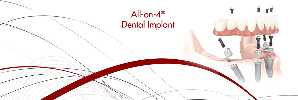Weatherford All-on-4 Dental Implants