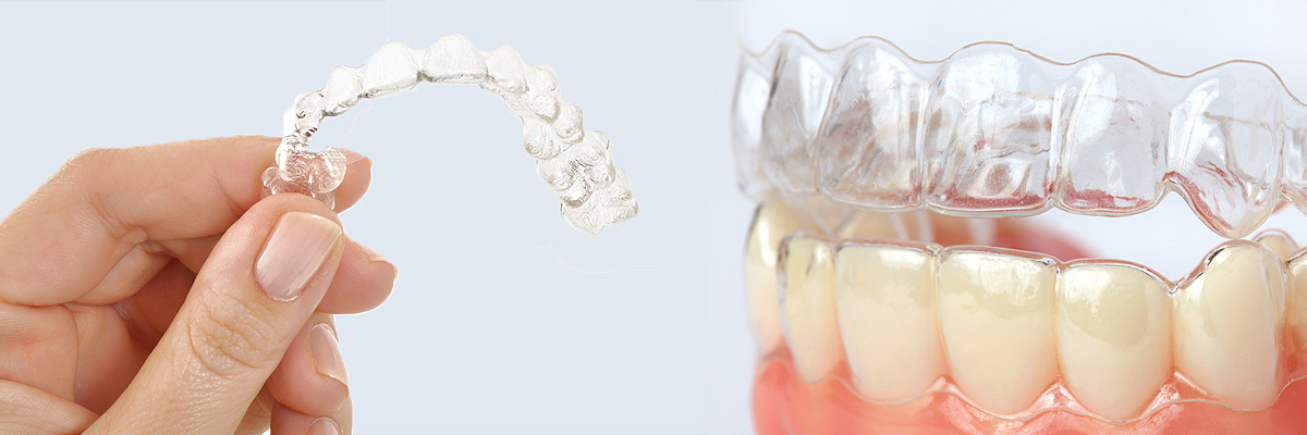 Weatherford Alternative to Braces for Teens