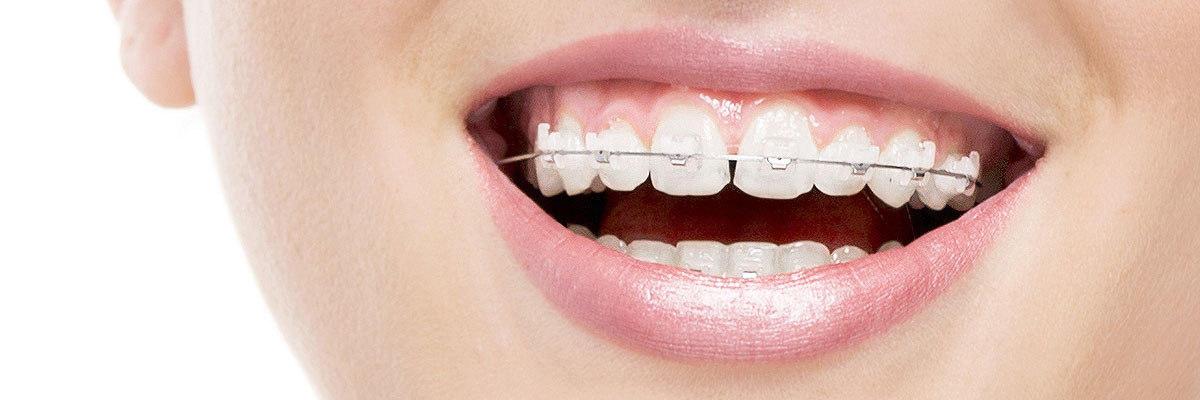 Weatherford Invisible Orthodontics