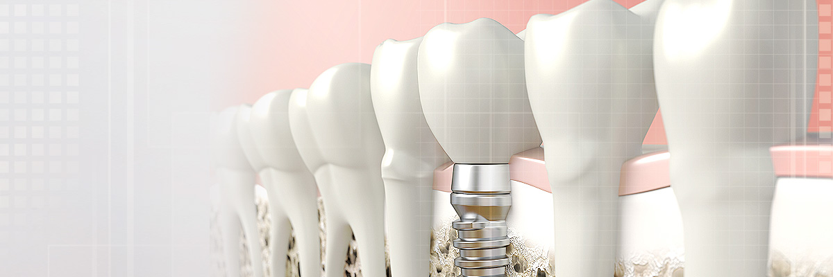 Weatherford Tooth Colored Fillings