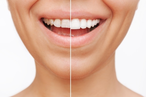 How Dental Bonding Is Used For Cosmetic And Restorative Dentistry