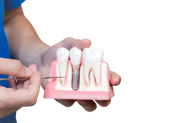 Replacing A Missing Tooth With A Single Dental Implant