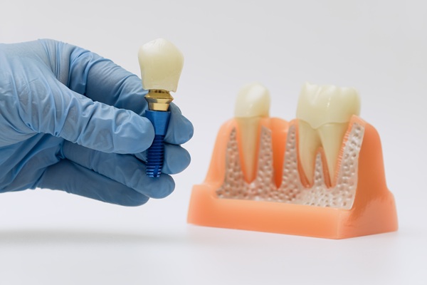 The Three Steps Of Getting Dental Implants