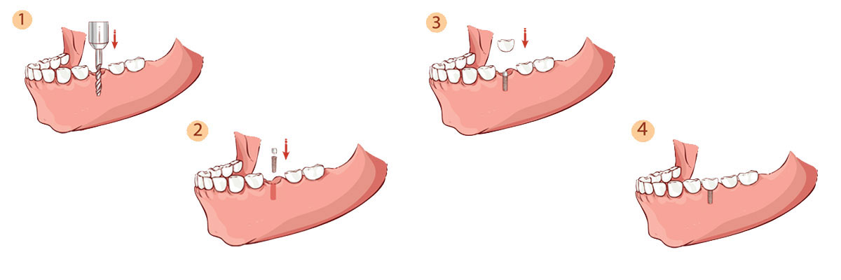 Weatherford Dental Implant Restoration