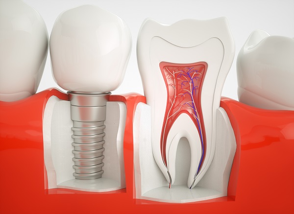 dental implant Weatherford, TX