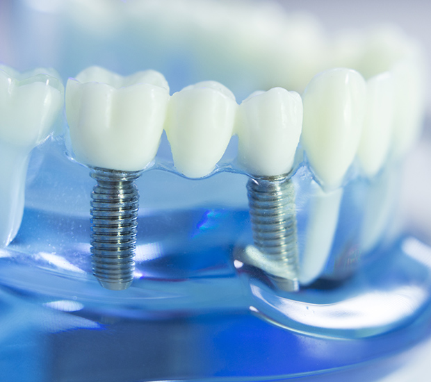 Weatherford Dental Implants