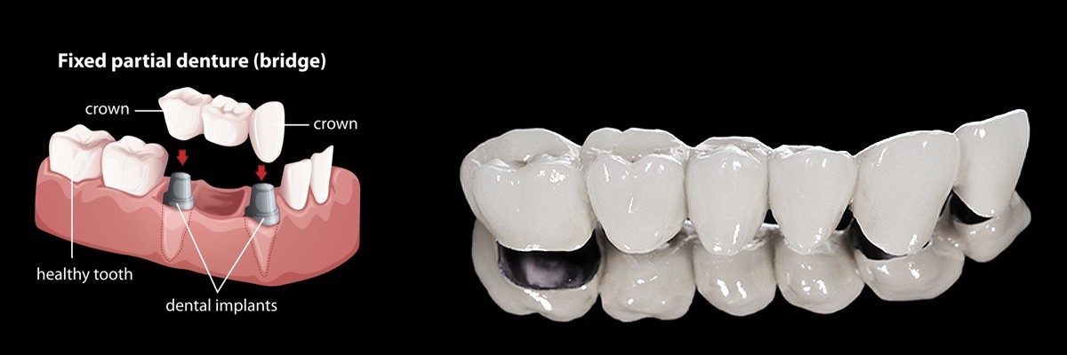 Weatherford Dentures