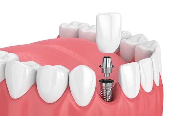 How Painful is Dental Implant Surgery from Millar Family Dentistry in Weatherford, TX