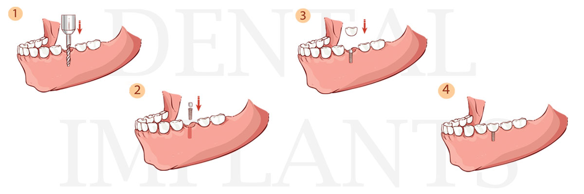 Weatherford The Difference Between Dental Implants and Mini Dental Implants