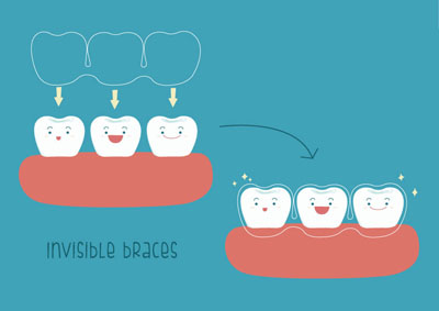 Invisalign® Dentist