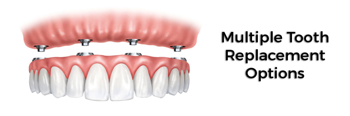 Weatherford Multiple Teeth Replacement Options