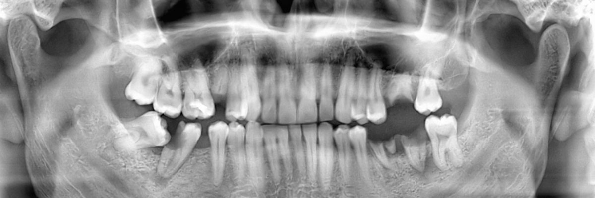 Weatherford Options for Replacing Missing Teeth