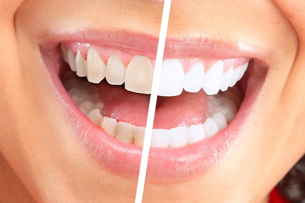 FAQs About Professional In Office Teeth Whitening