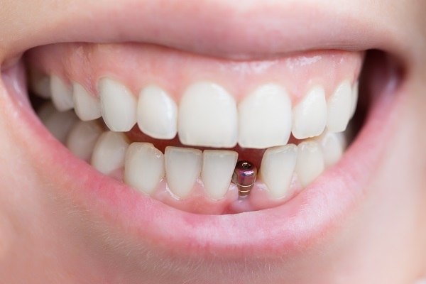 FAQs About Tooth Implants